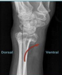 <p>distal radius fracture - smith fracture </p>