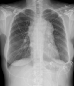 <p>the included image has an example of a mediastinal abnormality; what is it?</p>