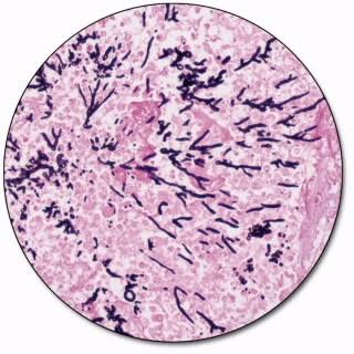 <p>Tissues with Aspergillus, Candida or <em>Pneumocytis</em></p>