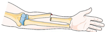 <p>One end of the broken bone tears through the skin. </p><ul><li><p>Carries high risk of infection </p></li></ul><p></p>