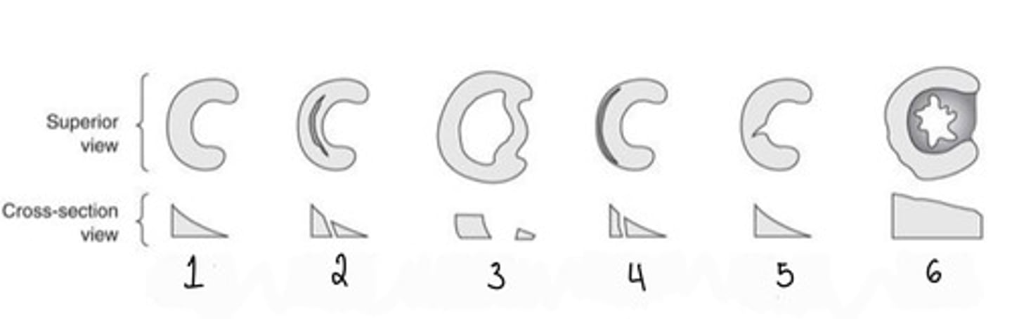 <p>What type of meniscal tear is 5?</p>