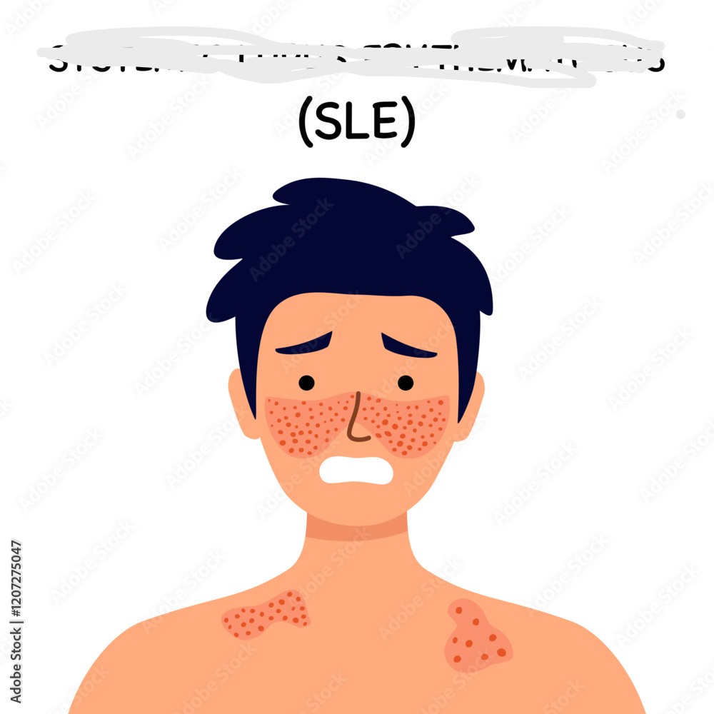 <p><strong>SLE</strong></p>