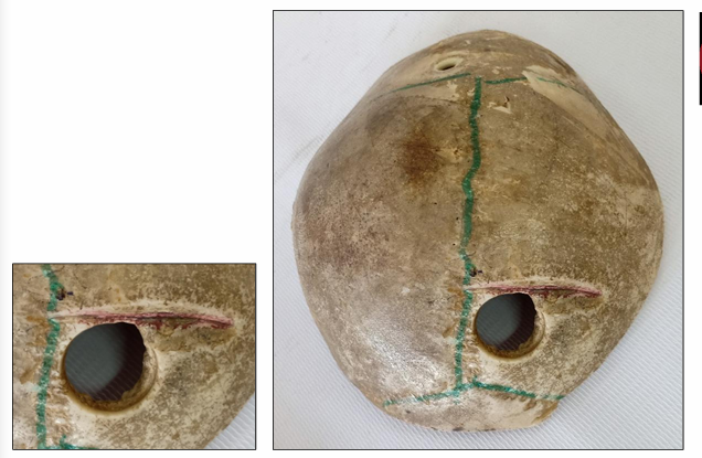 <p>Questions</p><ol><li><p>What is the specimen being examined?</p></li><li><p>What are the types and descriptive features of the injuries and surgical interventions on the skull?</p></li><li><p>What type of causative instrument produces the primary injury?</p></li><li><p>How is the time of death estimated?</p></li><li><p>What are the possible causes of death?</p></li><li><p>What is the final diagnosis for this specimen?</p></li></ol><div data-type="horizontalRule"><hr></div><p></p><p></p>