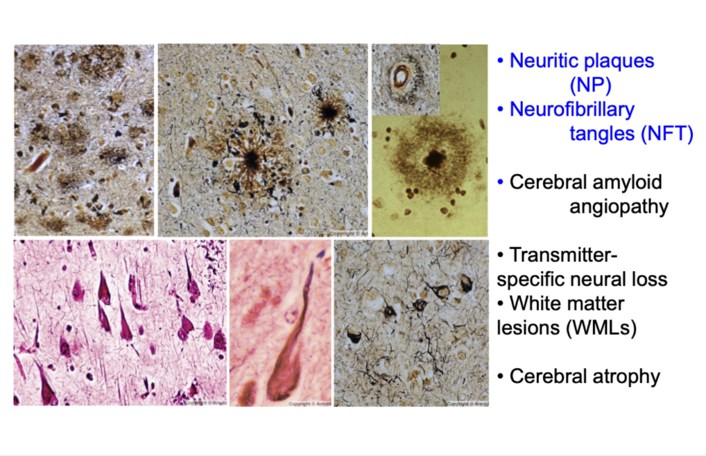 <ul><li><p>neuritic plaques (NP)</p></li><li><p>neurofibrillary tangles (NFT)</p></li><li><p>cerebral amyloid angiopathy</p></li><li><p>transmitter-specific neural liss</p></li><li><p>white matter lesions (WML)</p></li><li><p>cerebral atrophy</p></li></ul><p></p>