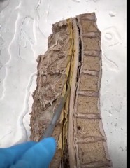 <p>Name the ligament</p>
