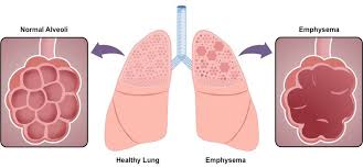 <p>Where the surface area of the alveoli decreases. Caused by smoking.</p>