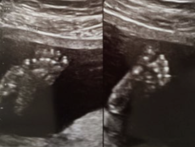 <ul><li><p>big toe angled medially</p></li><li><p>large gap between 1st and 2nd toe</p></li></ul><p></p>