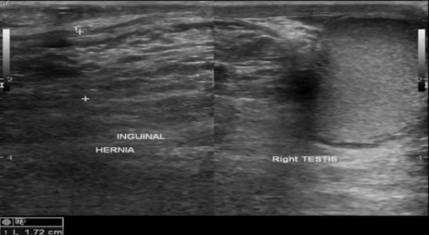 <p><span style="background-color: transparent;">Indirect inguinal hernia → can extend down to the scrotum</span></p>