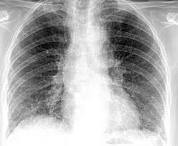 <p>abnormal lung condition with increased fluid between the alveoli and a decrease in lung function</p>