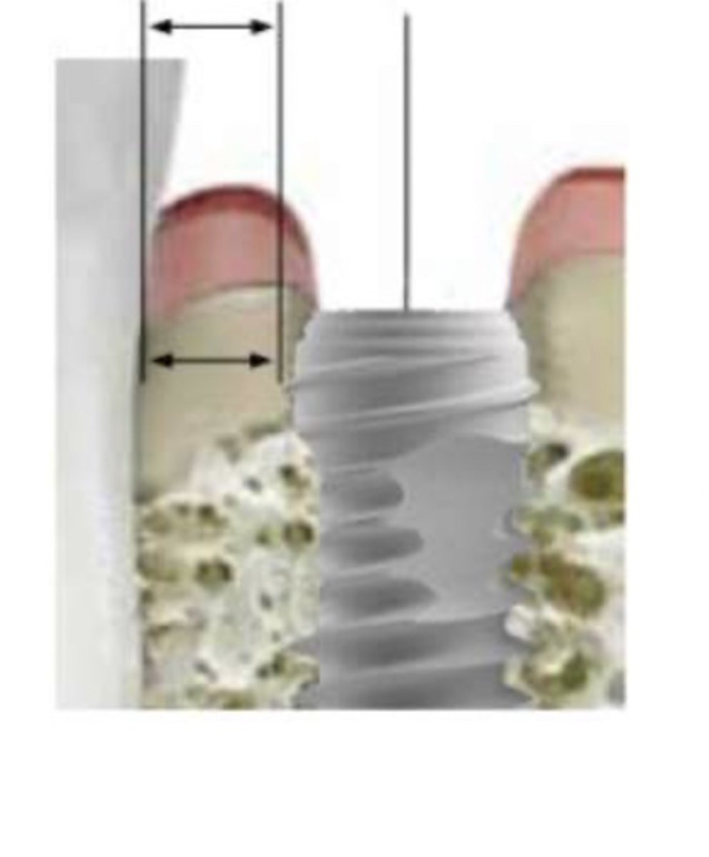 <p>How much space do we want between an implant and a neighboring tooth?</p>