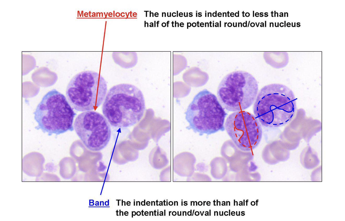 <p>Metamyelocyte or Band?</p>
