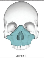 <p>fracture extends through maxilla, nasal</p><p>bridge, lacrimal bones, orbital floor and rim</p>