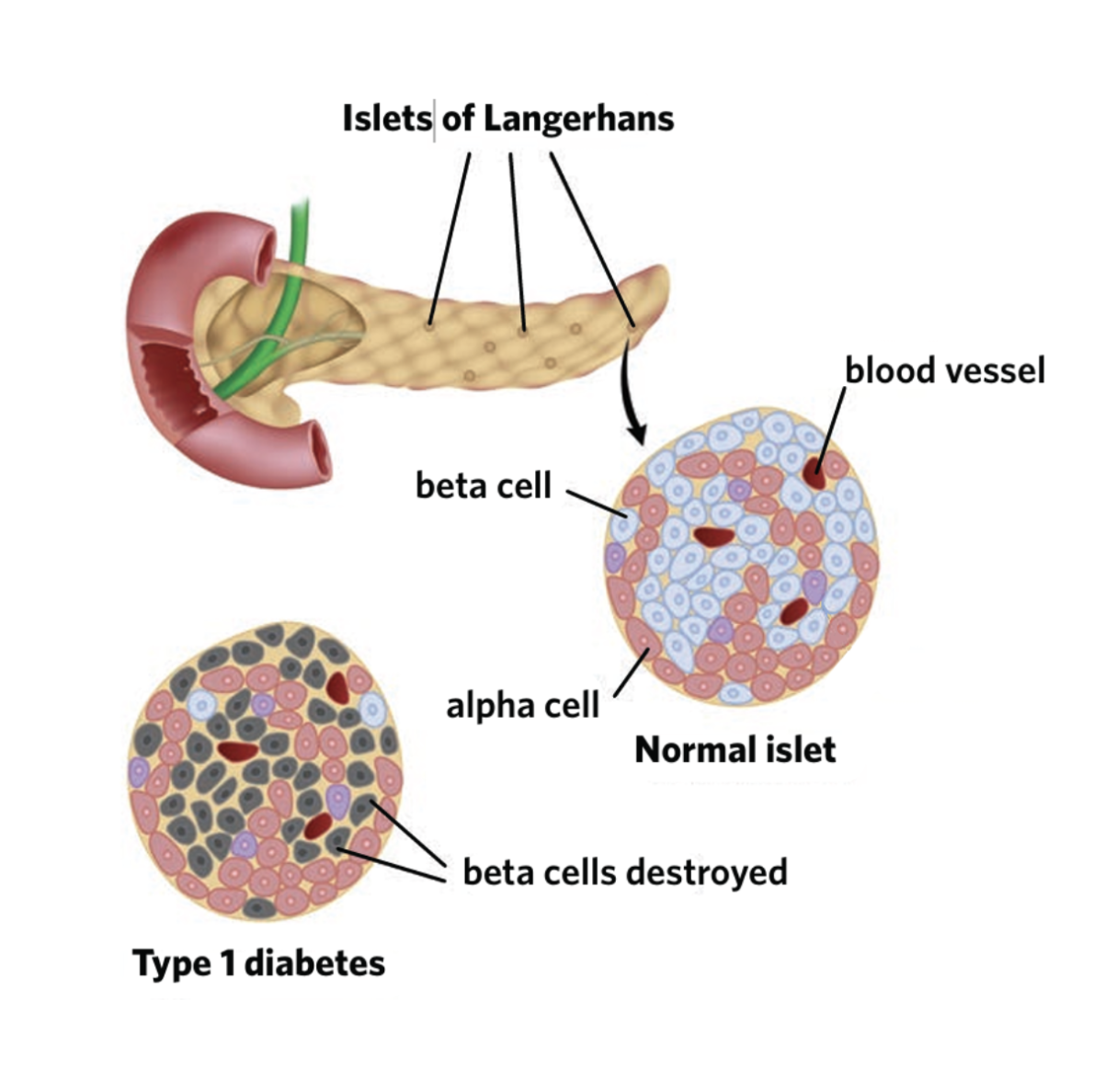 <p>-<span style="background-color: transparent;">body’s immune system recognises beta cells in the pancreas as non-self and attacks them using autoantibodies&nbsp;</span></p><p><br><strong>leads to </strong></p><p><span style="background-color: transparent;">- no insulin</span></p><p><span style="background-color: transparent;">-blood glucose are left un regulated</span></p><p><span style="background-color: transparent;">-alpha cells are also impaired and can no longer function properly.</span></p>