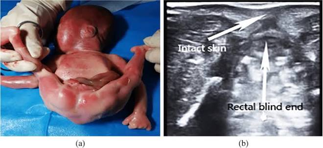 <p>imperforate anus</p>