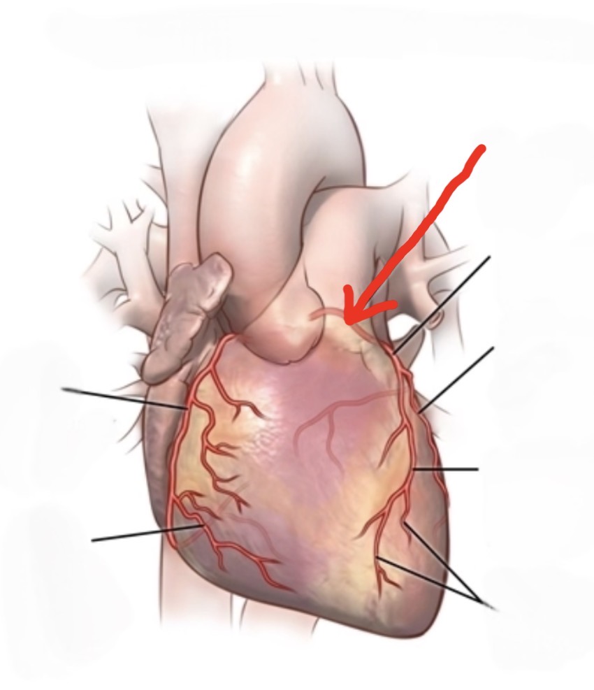 <p>Major artery supplying oxygen-rich blood to the left side and front of the heart muscle</p>