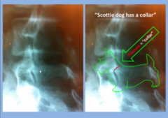 <p>stress fracture of pars interarticularis — common in adolescent athletes, e.g., gymnasts, football linemen</p>