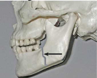 <p>whats a mandible fracture and some of its signs and symptoms?</p>