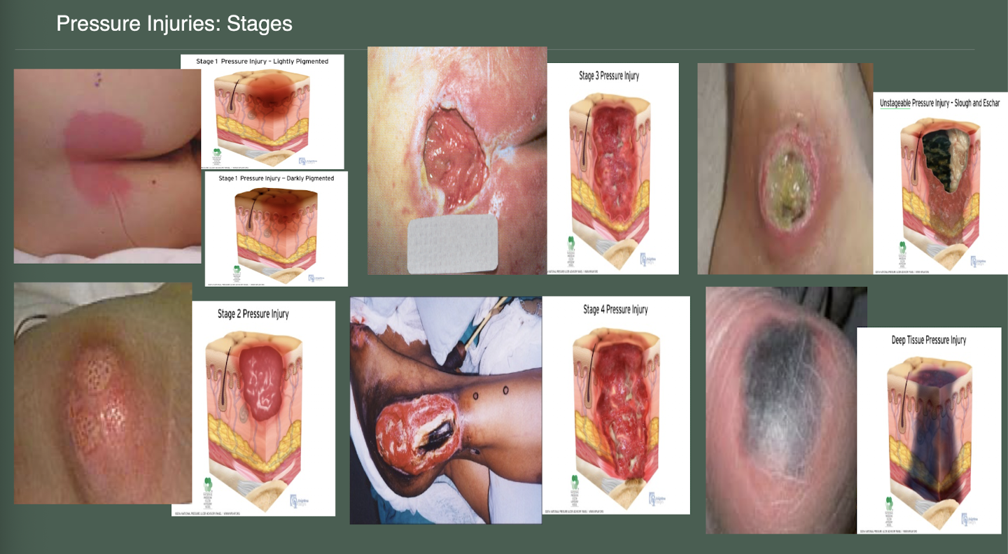 <p>stage 1- non blanchable</p><p>stage 2- partial thickness skin loss</p><p>stage 3- full thickness skin loss</p><p>stage 4- full thickness skin loss</p>