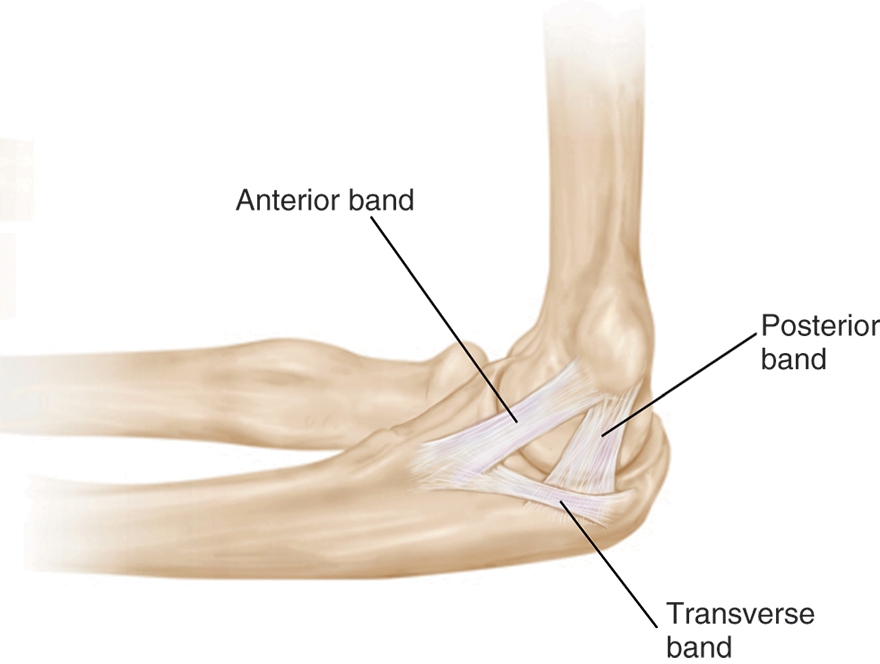 <p>Attachments</p><ul><li><p><span style="background-color: transparent; font-family: "Times New Roman", serif;">Medial epicondyle -> fans out into anterior and posterior bands&nbsp;</span></p><ul><li><p><span style="background-color: transparent; font-family: "Times New Roman", serif;">Ant: sublime tubercle on coronoid p</span></p></li><li><p><span style="background-color: transparent; font-family: "Times New Roman", serif;">Post: medial olecranon</span></p></li></ul></li><li><p><span style="background-color: transparent; font-family: "Times New Roman", serif;">Intermediate band between coronoid process &amp; olecranon</span></p></li></ul><p>Features</p><ul><li><p><span style="background-color: transparent; font-family: "Times New Roman", serif;">Triangular</span></p></li></ul><p>Functions</p><ul><li><p><span style="background-color: transparent; font-family: "Times New Roman", serif;">Lateral stability against valgus force</span></p></li></ul><p></p>