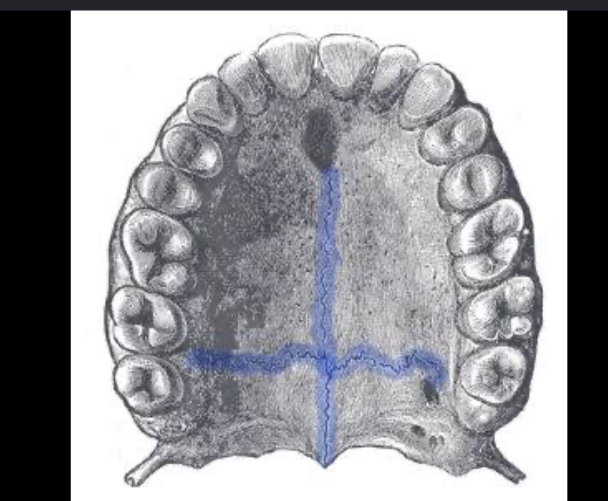 <p>Midline fusion of the palatine</p>