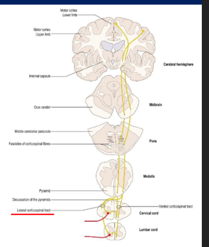 <p>progressive weakness of the legs &amp; muscle spasms, increased muscle tone &amp; marked stiffness in gait, caused by degeneration of lateral corticospinal tract</p>