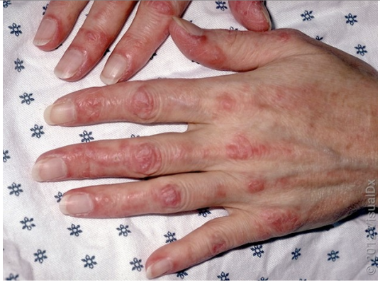 <p>A 50-year-old female presented with the following cutaneous findings. What condition should this patient be screened for?</p>