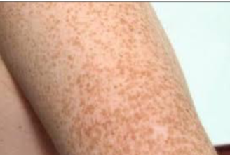 <p>clinically, a brown macule on face/arms/back that gets darker with UV light and is a benign increased in melanin deposition</p>