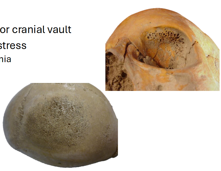 <p>Pathology: <span>Metabolic Diseases Example: Cribra orbitalia and Porotic hyperostosis</span></p>