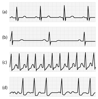 <p>This question refers to ECG traces in the figure below. If the trace in panel (a) depicts normal activity, which trace would be expected in a patient with a severed (non-functioning) vagus nerve?</p>