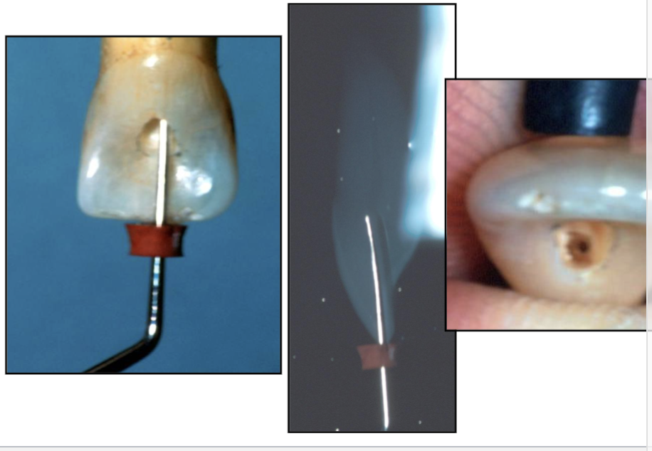<ul><li><p>how far are you in the pulp chamber?</p></li><li><p>are you under the incisal edge?</p></li><li><p>is your access large enough to have illumination to help locate the pulp space?</p></li></ul><p></p>