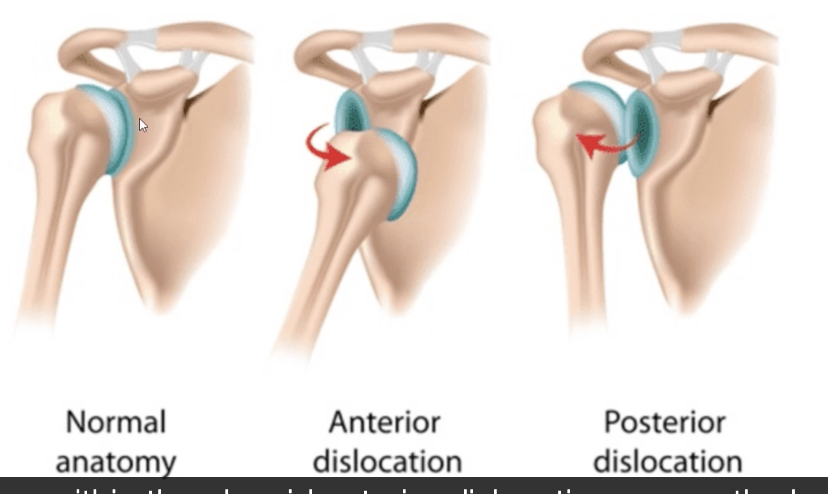 <p>Anterior or posterior dislocations<br></p>