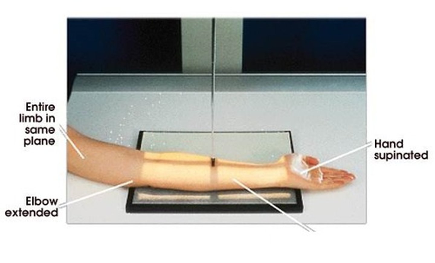 <p>S - around waist</p><p>T - 6 mAs @ 60 kVp</p><p>A - none</p><p>M- correct marker on cassette</p><p>P - CR midforearm, epicondyles parallel to IR, hand supinated</p><p>S - 40</p><p>B - suspension</p><p>C - 14 by 17</p>