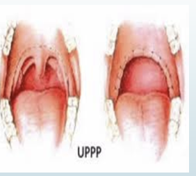 <p>Removal of obstructing tissues that black tonsillar pillars, uvula, and postieorir soft palate</p><p>Allows for winder opening of the pharnyx reudicn gthe risk of tissue collapse</p>