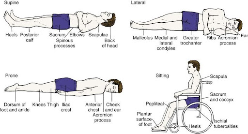 <p>Based on this figure, name two common pressure sites in the lateral (side-lying) position.</p>