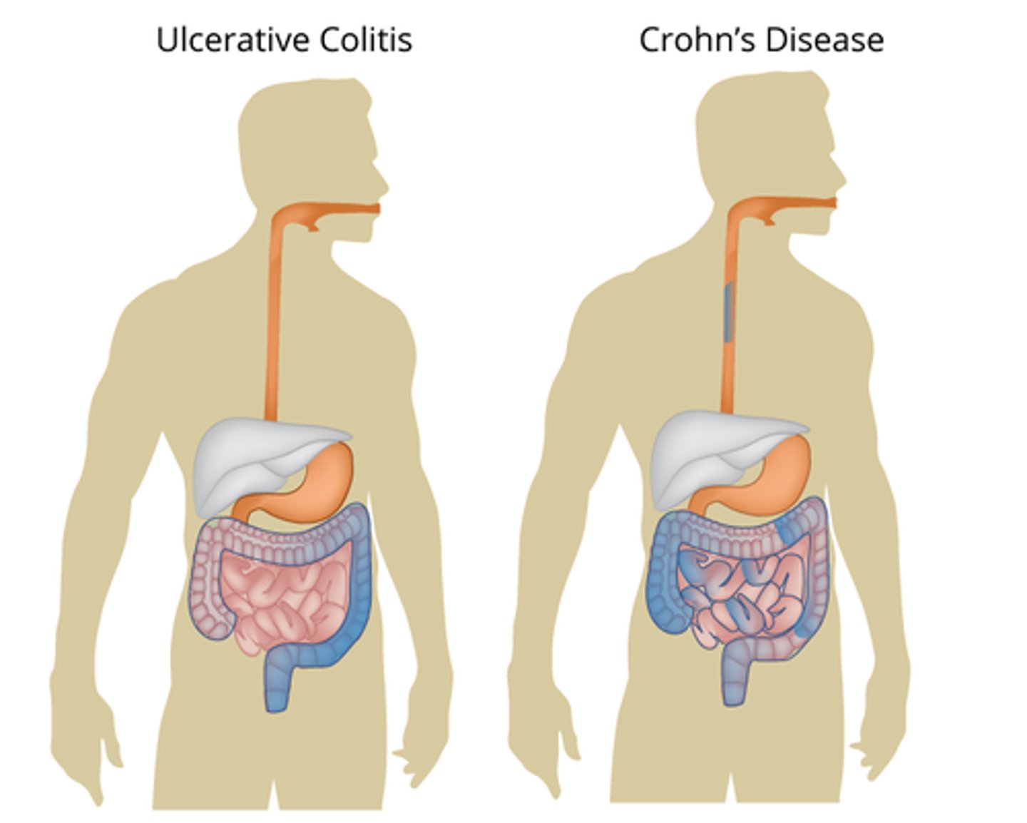 <p>B) Crohn’s disease: autoimmune disorder causing skip lesions with a cobblestone appearance anywhere from mouth to rectum; Ulcerative colitis: autoimmune disorder causing ulcerations in the rectum and large intestine</p>