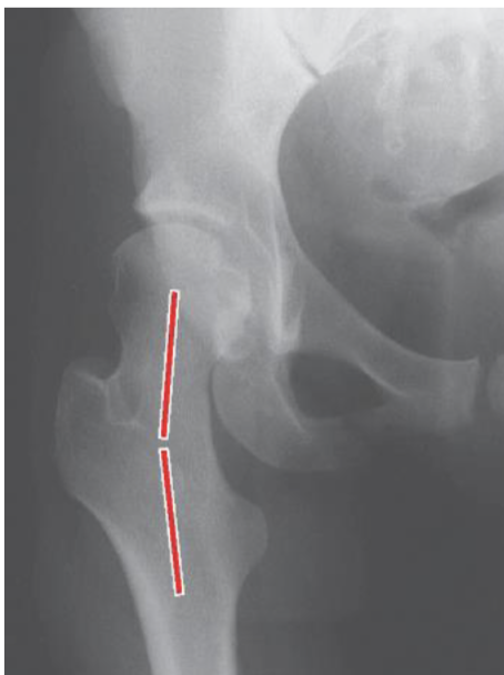 <p><strong>Coxa Valga</strong>  (<span>Femoral Head Coverage (Area),  MA of Glut Med, Force Needed from Glut Med, Joint Stress, Bending Moments)</span></p>