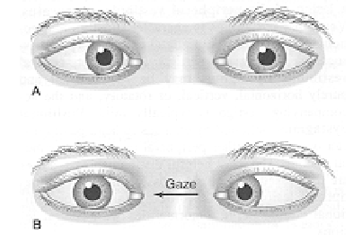 <p>results in a loss of abduction beyond the midline, causing diplopia when patients attempt to look in the direction of the paralysed lateral rectus muscle</p>