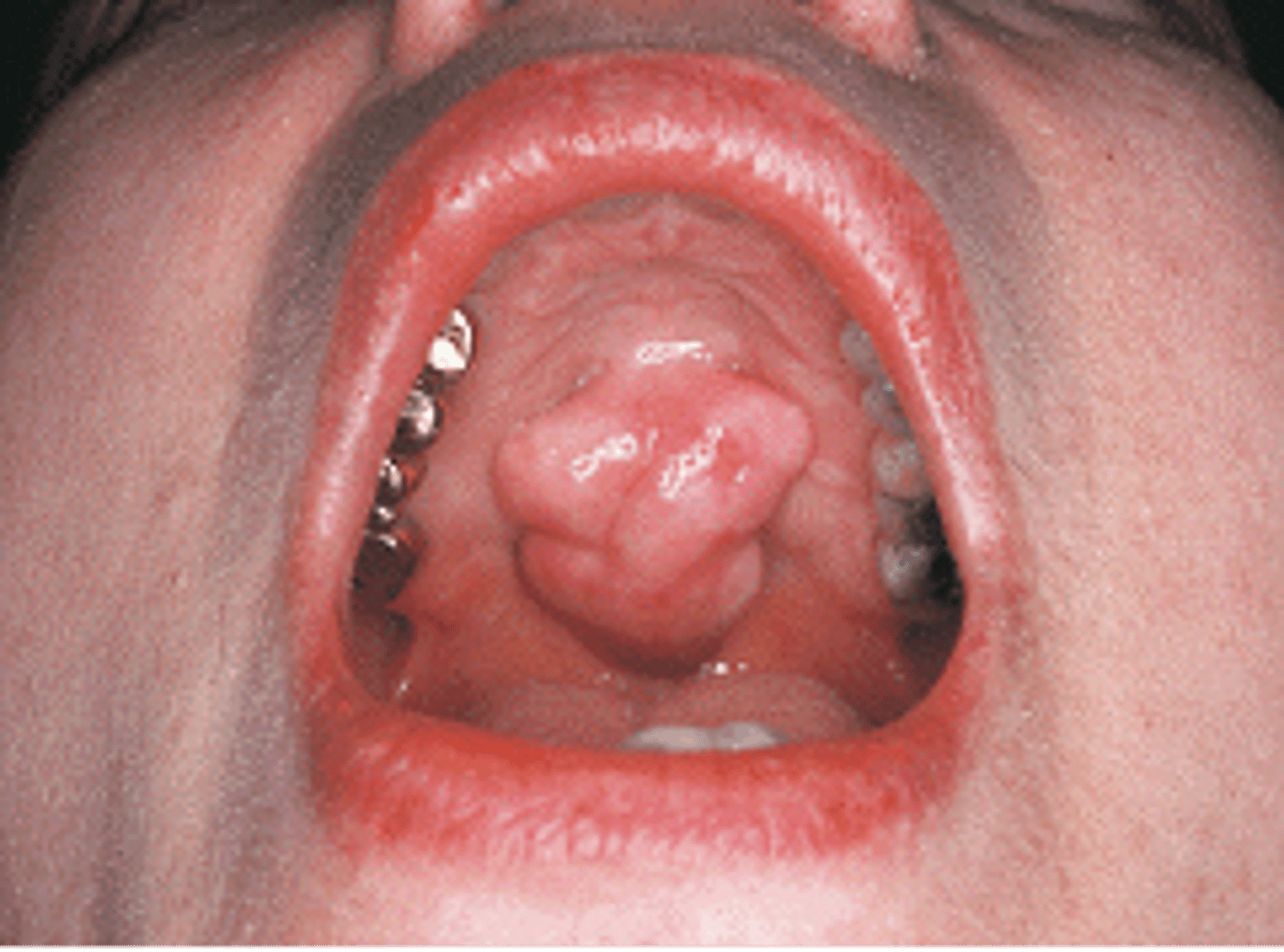 <p><br></p><p>Tori on the palate with defined lobules</p>