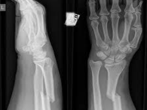 <p>Radius fracture with dislocation of the distal radioulnar</p><p>joint</p>