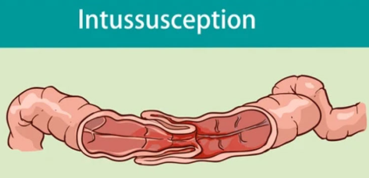 <ul><li><p>bowel blockage in <span style="color: rgb(227, 70, 70);"><strong>3 mon.-6 yrs</strong></span><strong> </strong>where part of intestine <span style="color: rgb(243, 78, 78);"><strong>telescopes </strong></span>into another</p></li></ul><p></p>