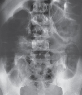<ul><li><p>Occurs more often than mechanical bowel obstruction</p></li><li><p>Common disorder of intestinal motor activity</p></li><li><p>Fluid and gas do not progress normally</p></li></ul><p></p>