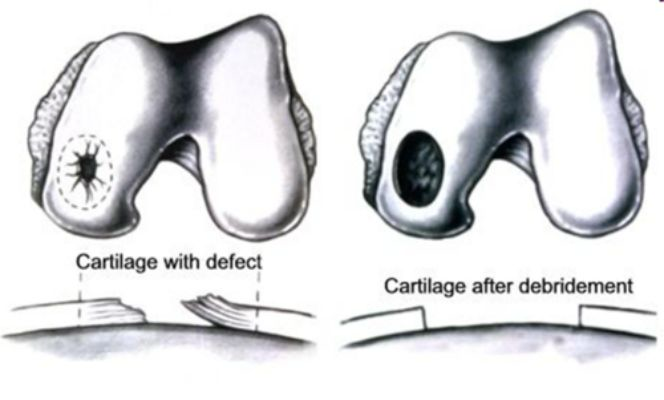 <p></p><ul><li><p>The "first" and "easiest" method of repairing articular cartilage</p></li><li><p>Performed in there is <strong>fraying of the Articular Cartilage</strong> </p></li><li><p>The debridement will help to "clean up" the fraying / fibrillation of the tissue</p></li></ul><p></p>