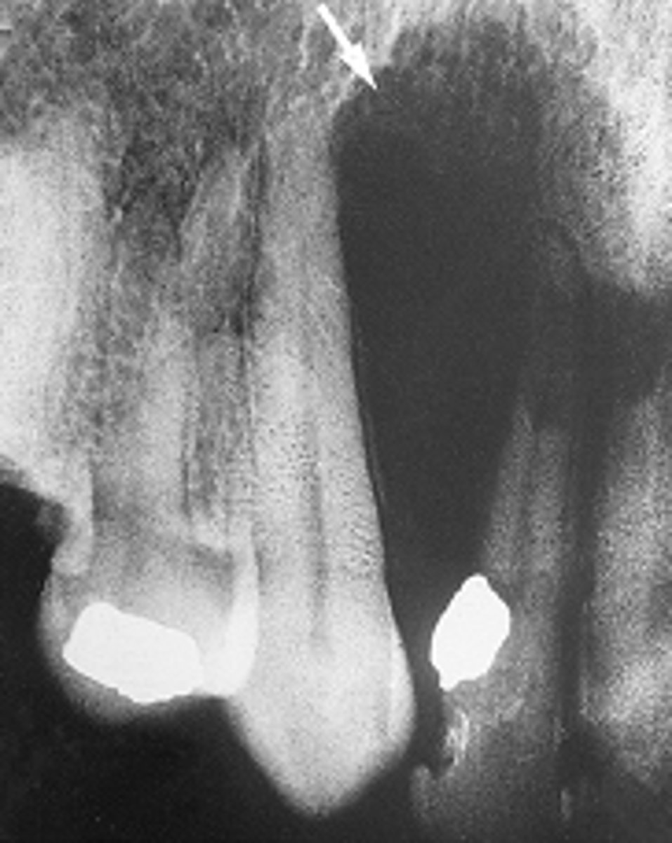 <p><br>well-defined, pear-shaped radiolucency found between the roots of the maxillary lateral incisor and canine</p><p><span>The pear-shaped radiolucency seen in this radiographic image was historically referred to as what type of cyst?</span></p>