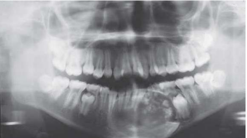 <p>A 30 year old female presented with complaint of swelling in the lower jaw. Intraorally a swelling was not over the left vestibule spanning over 43 to 35. Provide differential diagnosis.</p>