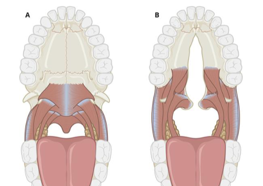 <p>• Muscles of a submucous cleft are often affected in the same way as with a complete cleft palate</p><p>• Levator muscles insert on the posterior border of the hard palate rather than in the middle of the velum (called “muscles of Veau”)</p>