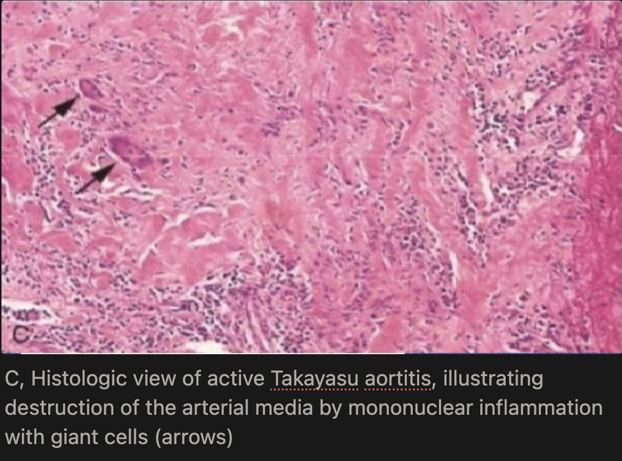 <p>Early on, inflammation starts in the outer layer (adventitia) with mononuclear cells clustering around the small vessels (vasa vasorum), then spreads into the media, where it becomes granulomatous with giant cells and causes patchy necrosis. Later, as healing occurs, the vessel wall develops collagen scarring with chronic inflammation affecting all three layers (adventitia, media, and intima), leading to permanent structural damage.</p>