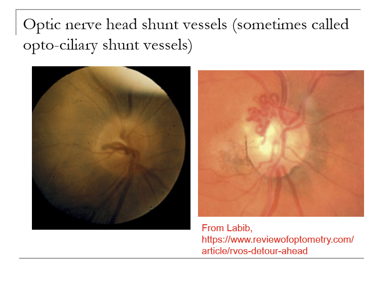 <ul><li><p>Congenital: does not mean much; pts are fine</p></li><li><p>Glaucoma: if IOP high enough, will crush optic nerve and central vein or artery. </p></li><li><p>Optic nerve tumor (progressive VF defect or central visual loss, optic atrophy, optic nerve head edema)</p></li><li><p>Post-CRVO </p></li></ul><p></p>