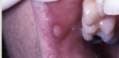 <p>Symptomatic care / topical therapy.</p>