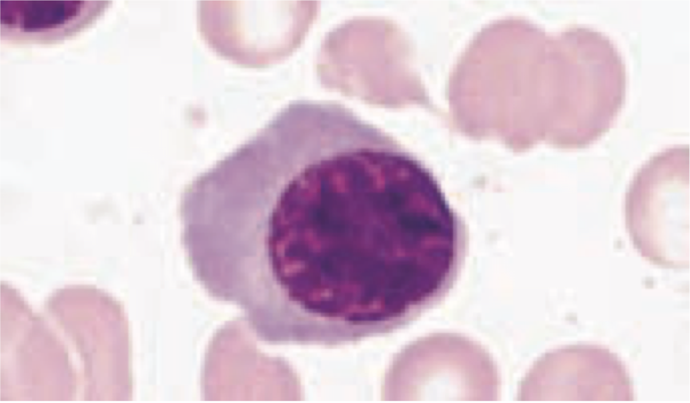<p>3rd stage of erythrocyte formation</p><ul><li><p><strong>diameter:</strong> 12-15 micrometers</p><ul><li><p>½ size of mother cell</p></li></ul></li><li><p><strong>nucleus:</strong></p><ul><li><p>smaller nucleus and more cytoplasm (chromatin is being condensed)</p></li><li><p>irregular chromatin and coarsely clumped due to chromatin aggregation</p></li><li><p>nucleoli are NO LONGER visible</p></li></ul></li><li><p><strong>cytoplasm:</strong></p><ul><li><p>abundant gray-blue/pink mixture from Hb and RNA</p></li><li><p>Hb is apparent in blue cytoplasm</p></li></ul></li><li><p>30 hrs to mature</p></li></ul><p></p><p></p>