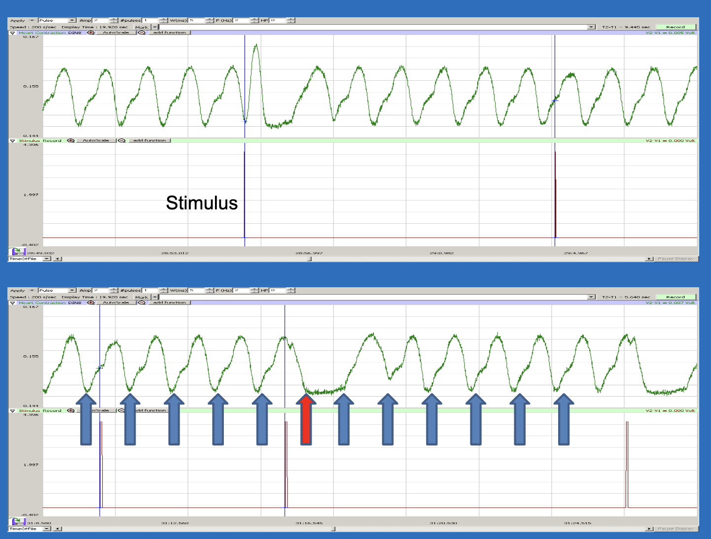 <p>autonomic nervous system's<span> control over the heart. The heart rate "reset" or slowing after the stimulus suggests a </span>parasympathetic (vagal) response<span>, where the body briefly slows the heart in response to a sudden input before returning to homeostasis</span></p><ul><li><p>cannot go into tetanus because the refractory period is long, but can “skip” a beat if a stimulus is sent right at the end of the period</p></li></ul><p></p>